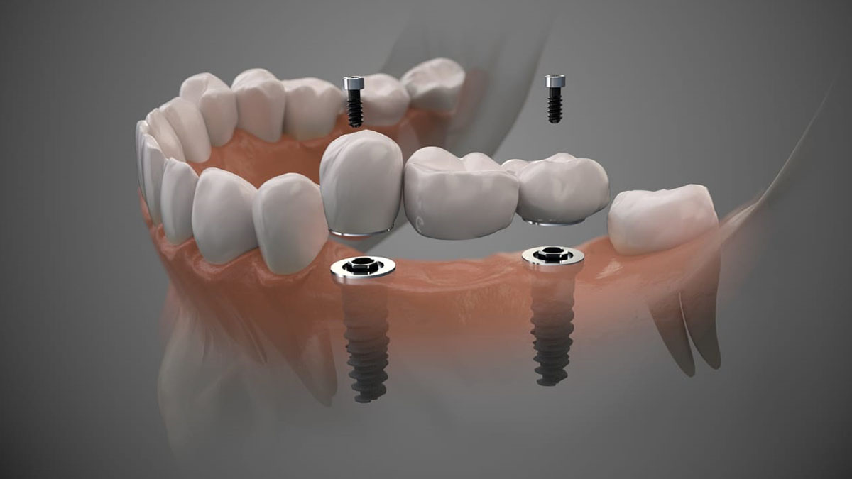 Implantes / Próteses