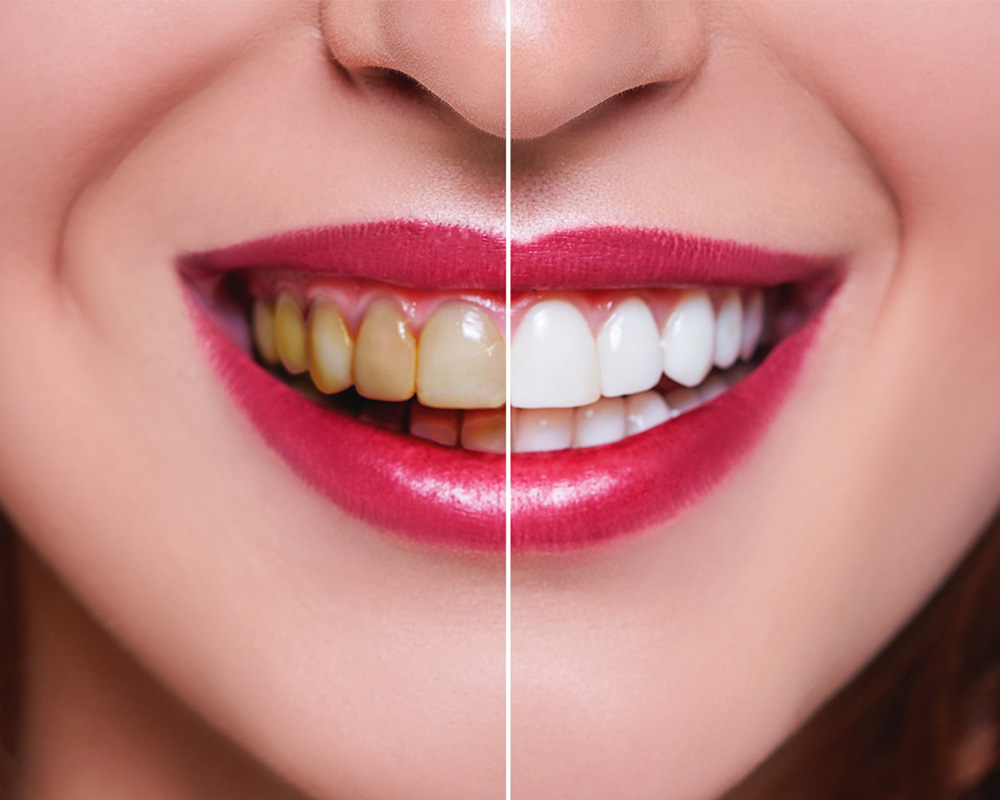 Clareamento Dental