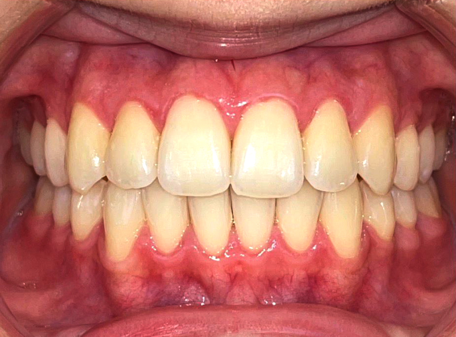 Invisalign Transformation - After