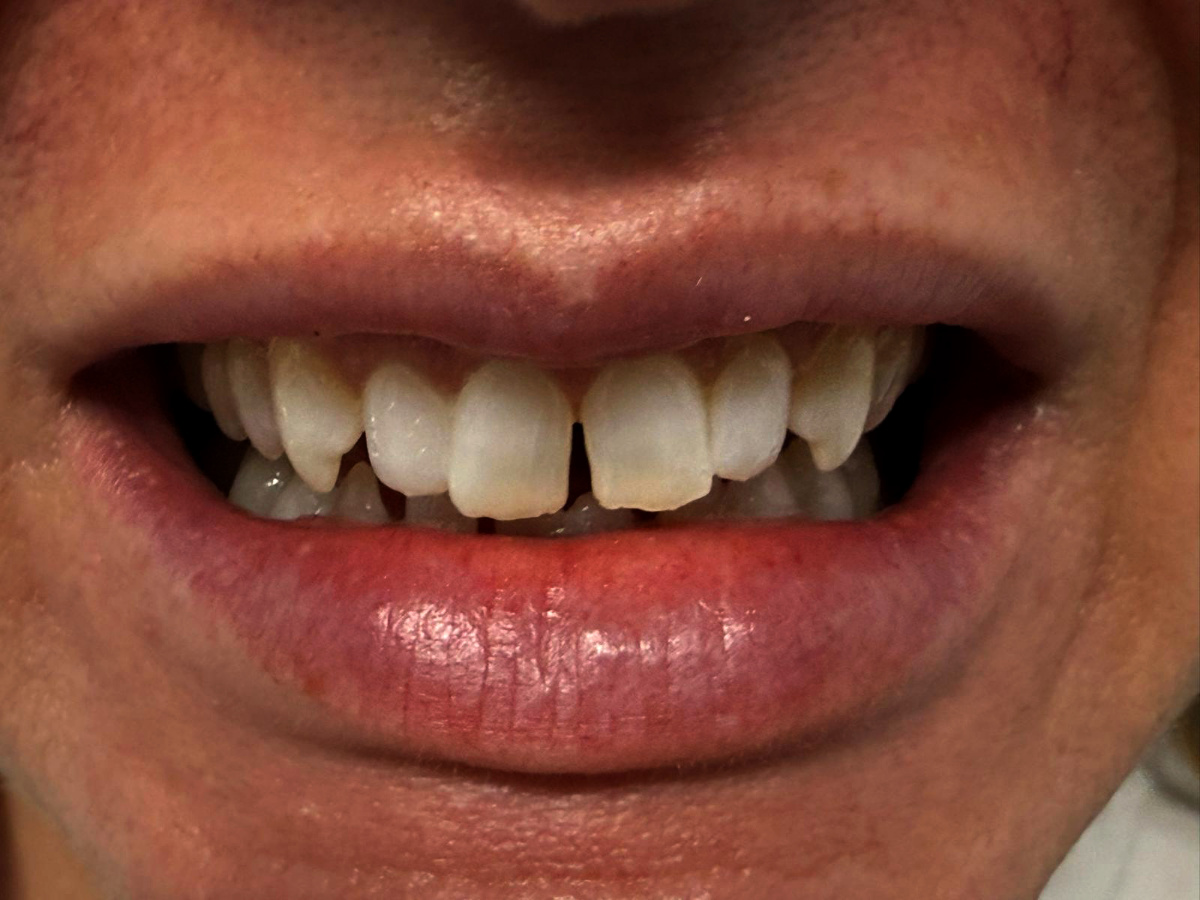 Composite Bonding - Before