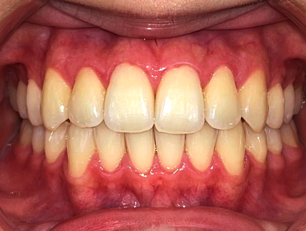 Comprehensive Teeth Alignment After Treatment — Invisalign orthodontic case showing final aligned smile result