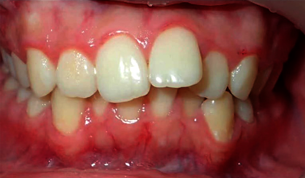 Before Invisalign Overbite Treatment