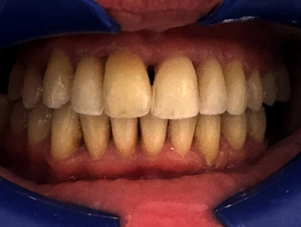 After Invisalign Chelmsford Essex