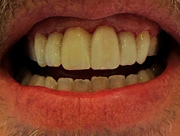 After Invisalign Treatment Beaulieu Dental