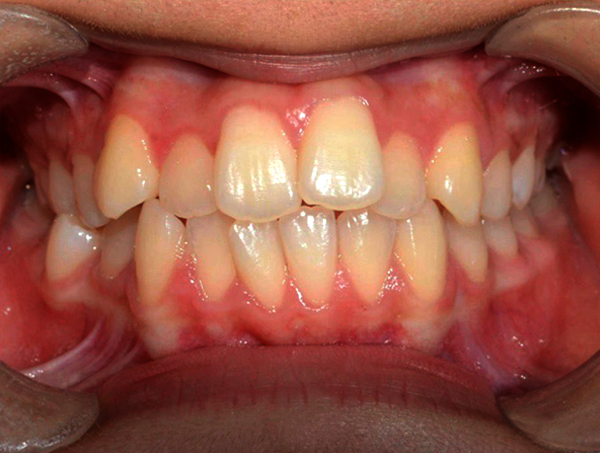 Comprehensive Teeth Alignment Before Treatment — Invisalign orthodontic case showing initial dental condition