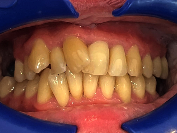 Before Invisalign Chelmsford Essex