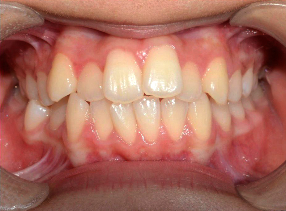 Invisalign Transformation - Before