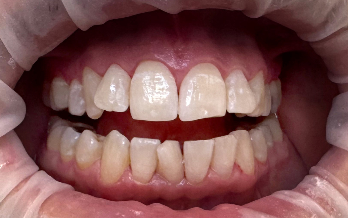 Teeth Whitening - After