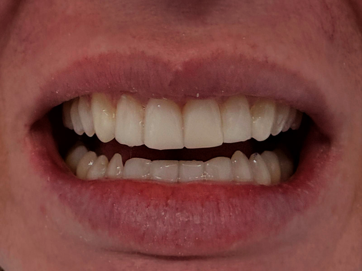 Composite Bonding - After