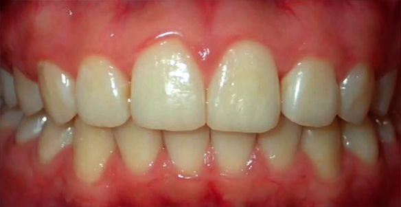 After Invisalign Overbite Treatment