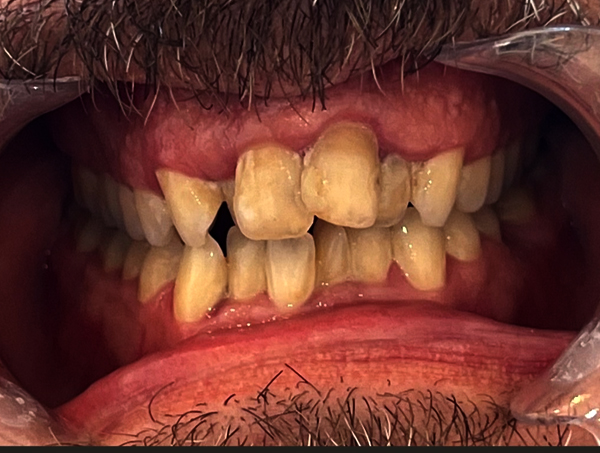 Before Invisalign Treatment Beaulieu Dental