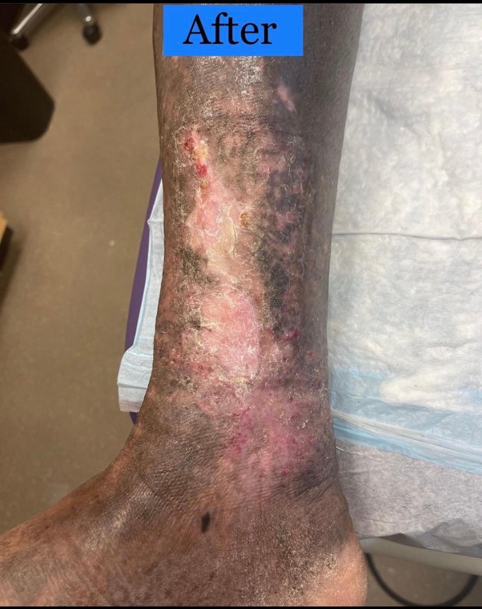 Tratamiento de úlcera caso 2