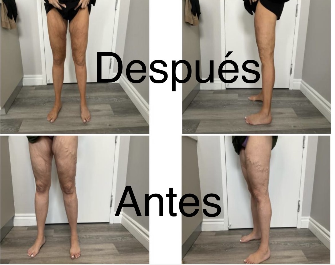 Varices en las piernas caso 2