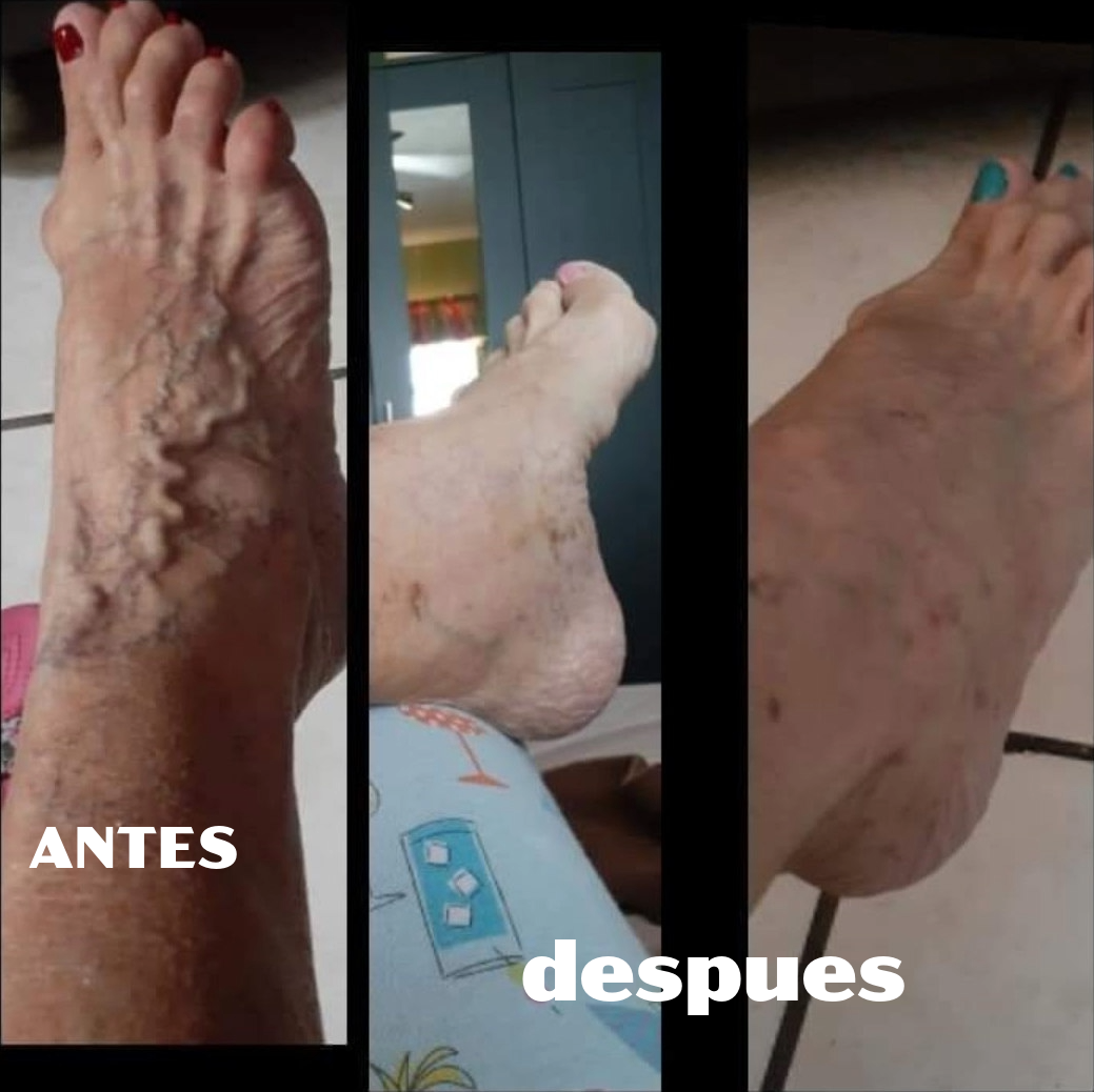 Varices en las piernas caso 1