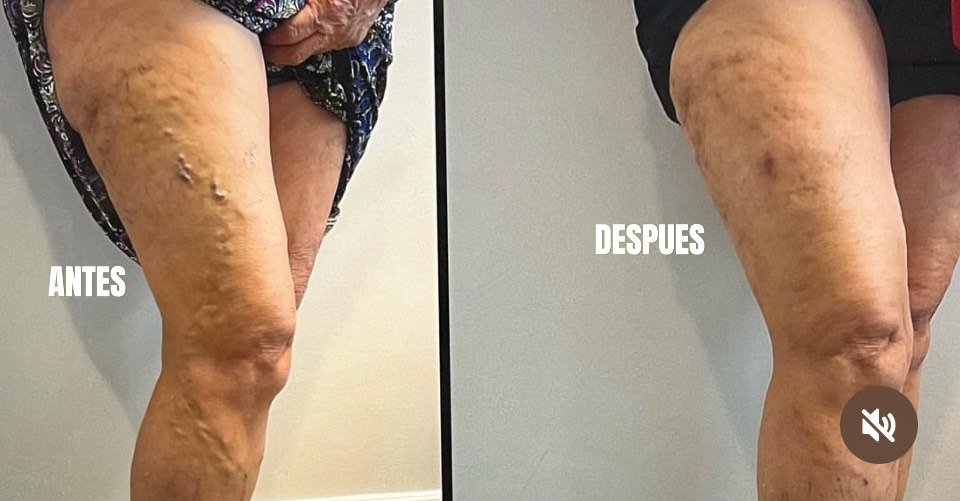 Antes y después tratamiento varices en las piernas