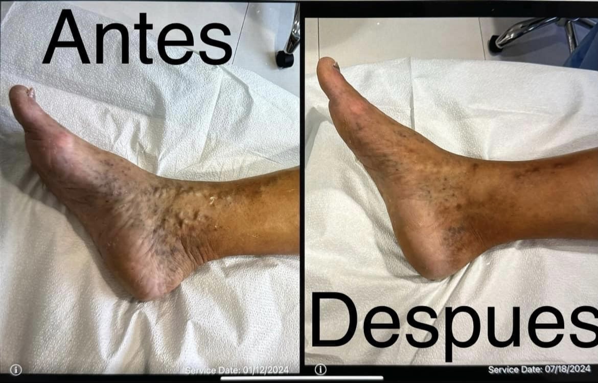 Tratamiento de úlcera caso 3