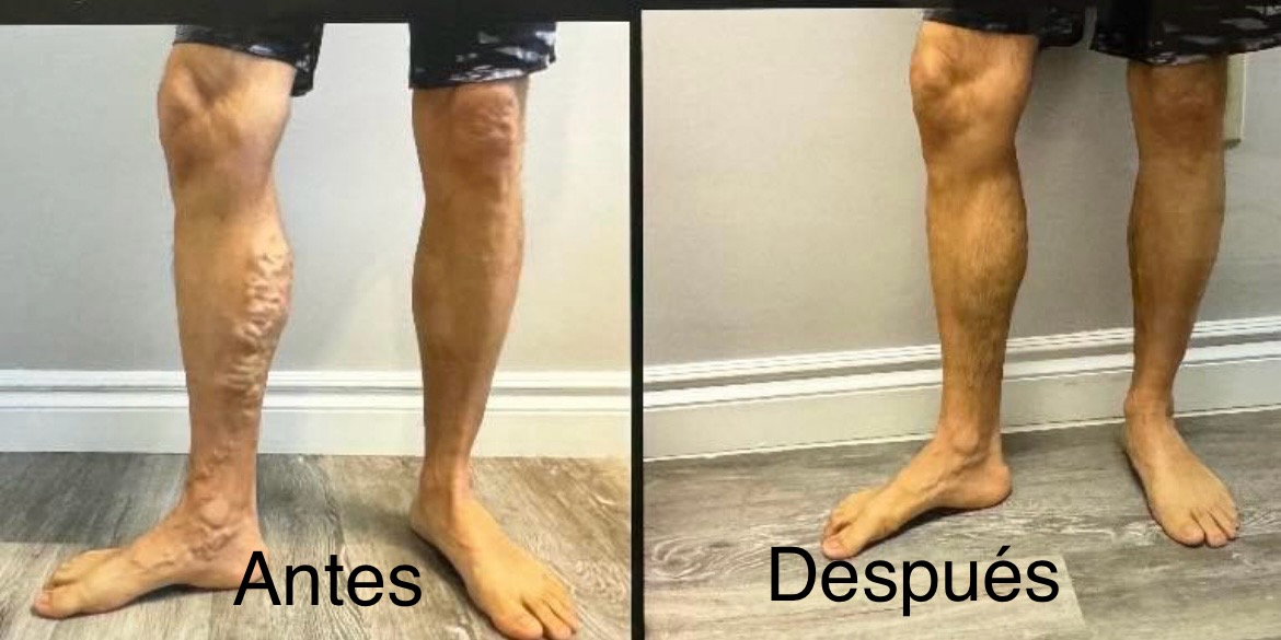 Varices en las piernas caso 3