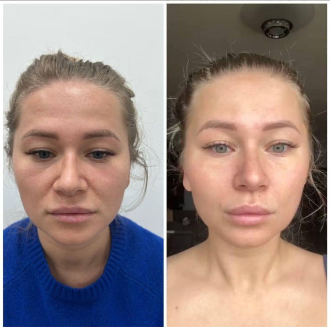 Soin Plasma froid Mons