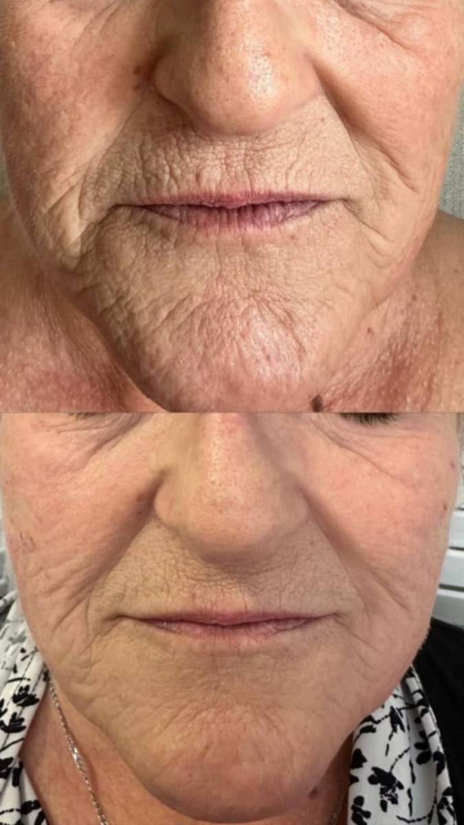 Soin au plasma froid