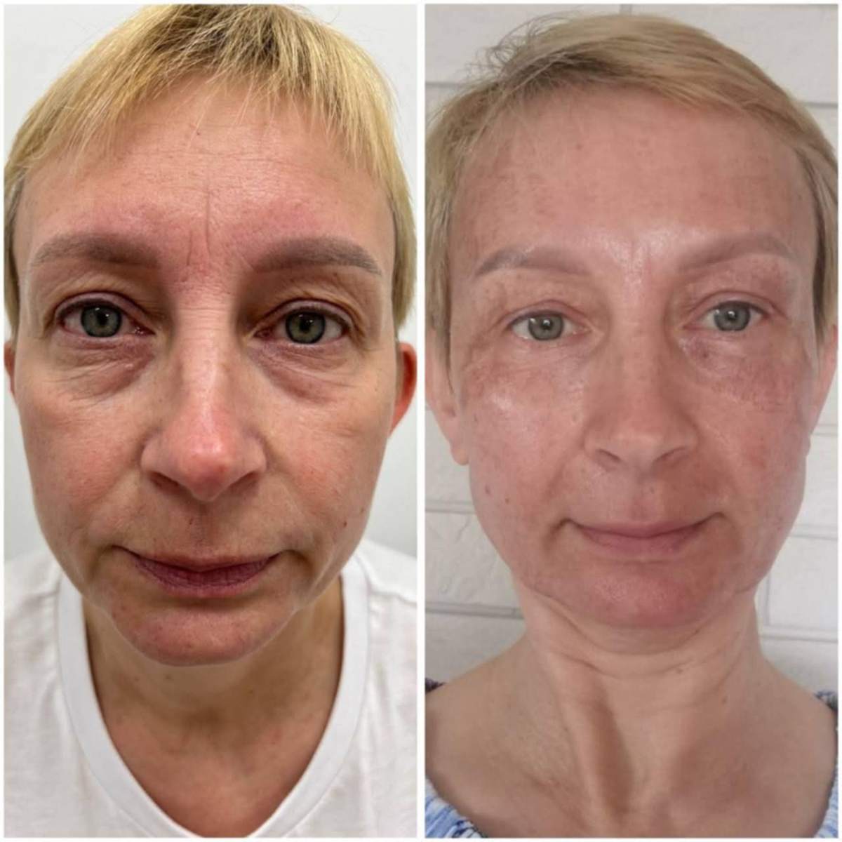 Avant le traitement Plasma froid