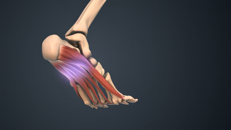Anatomical diagram of foot showing plantar fascia location and pain points