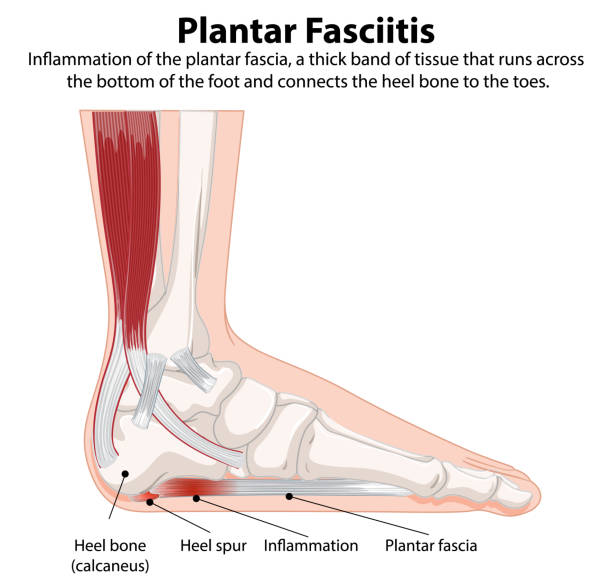 Plantar Fasciitis - Inflammation of the plantar fascia showing heel bone, heel spur, inflammation, and plantar fascia