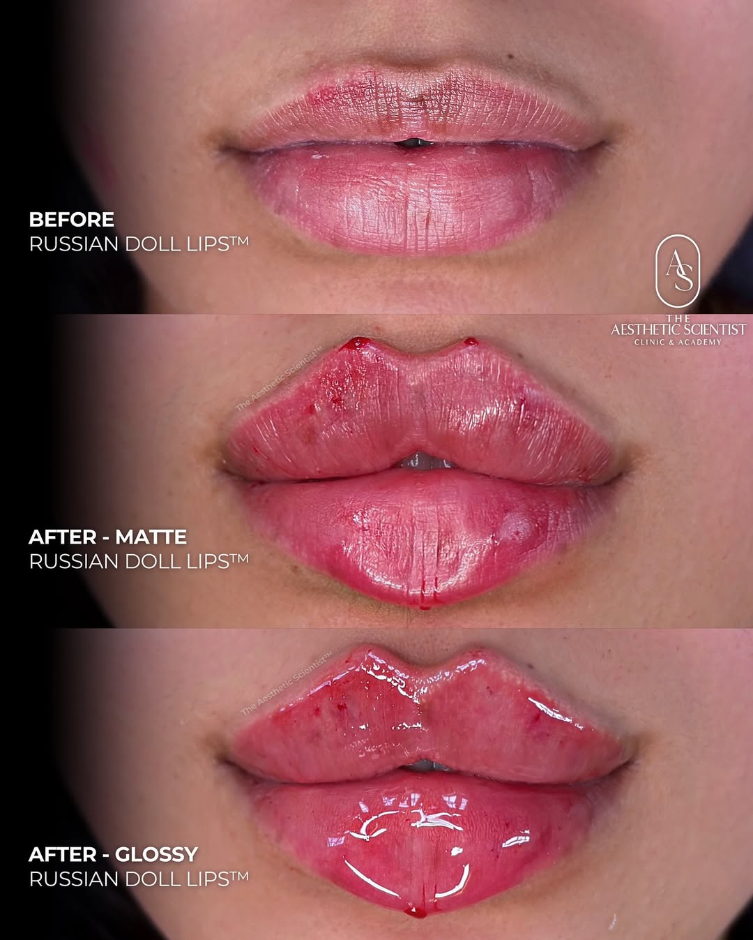 Cheek contouring result