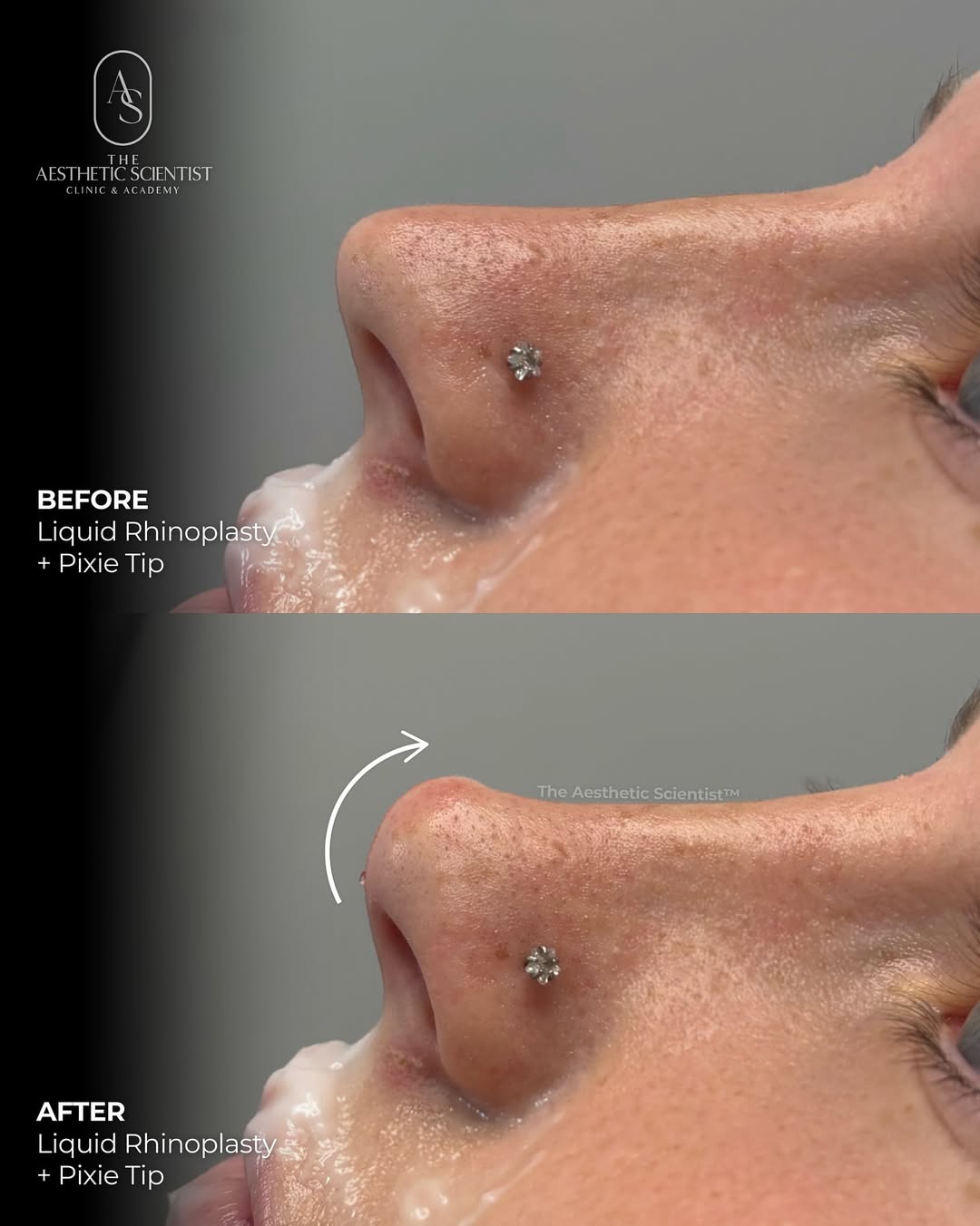 Skin rejuvenation result