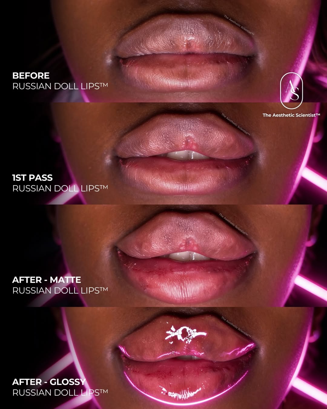 Lip treatment result