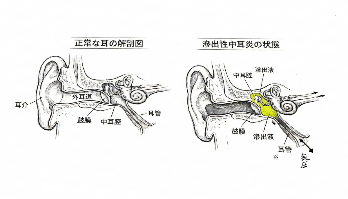 滲出性中耳炎の解剖図
