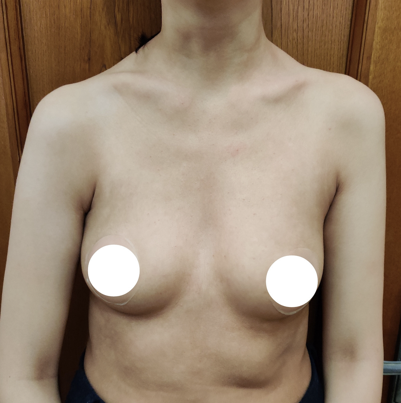 34歳のお客様 施術前
