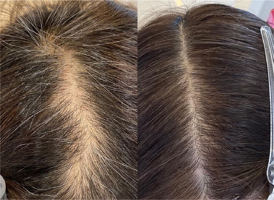 頭皮のビフォーアフター比較