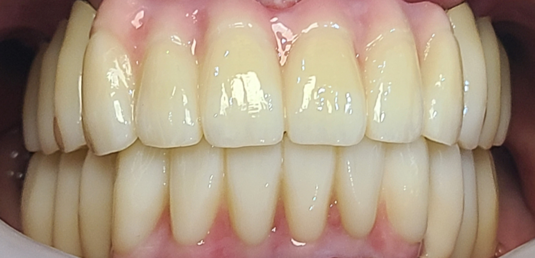 오래된 틀니가 들썩여서 못쓰겠어요. 다른치과에서 임플란트 힘들다고 들었어요. 명지이편한치과에서 어려운 임플란트 가능한가요? after