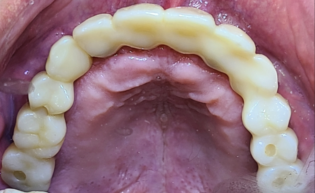 치아가 전반적으로 다 흔들리고, 씹지도 못하겠고 아파요 after