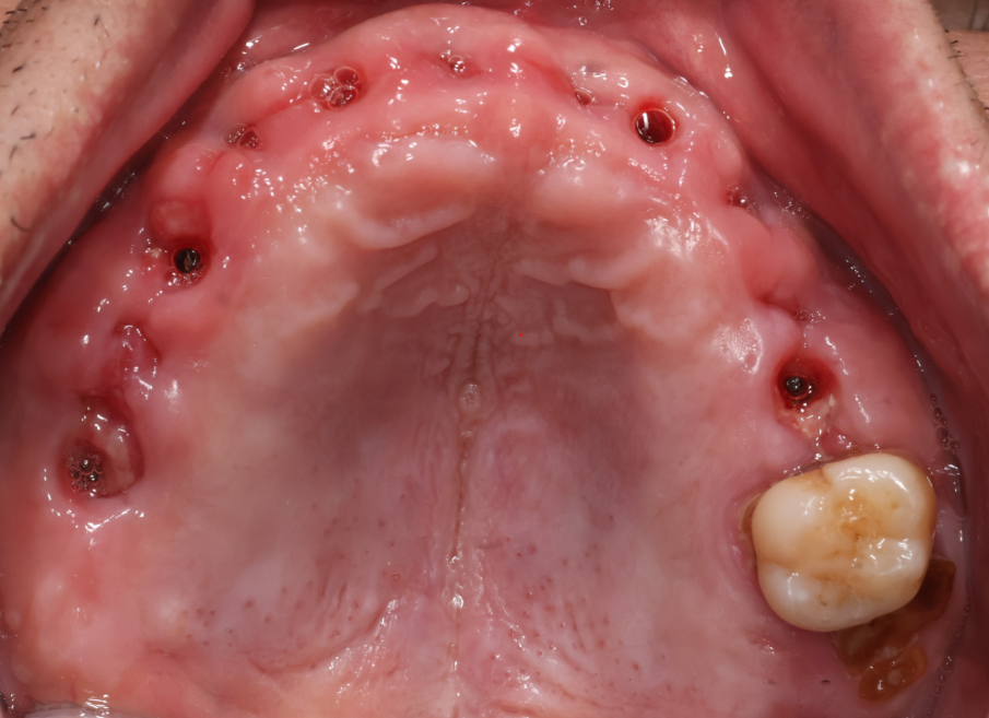치아가 전반적으로 다 흔들리고, 씹지도 못하겠고 아파요 before