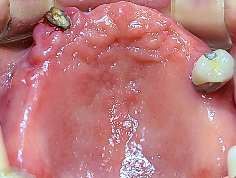 오래된 틀니가 들썩여서 못쓰겠어요. 다른치과에서 임플란트 힘들다고 들었어요. 명지이편한치과에서 어려운 임플란트 가능한가요? before