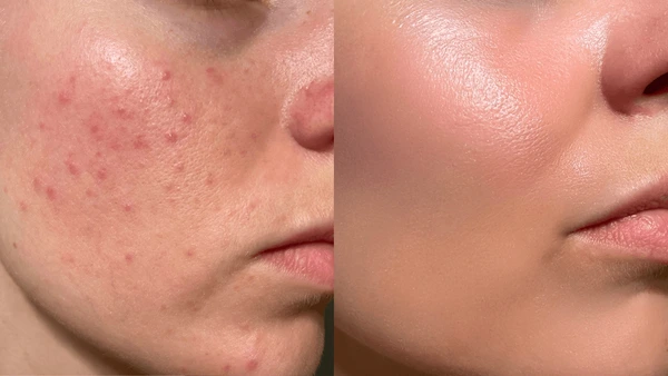 Before and After SkinFix