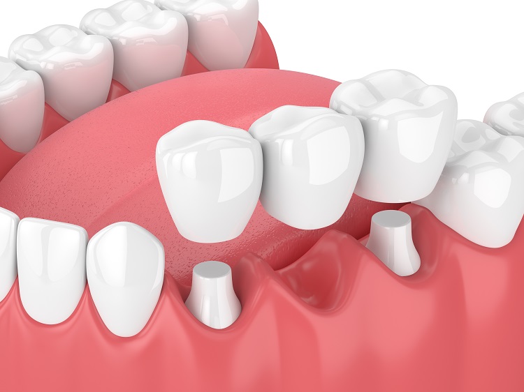 Fixed Prosthodontics