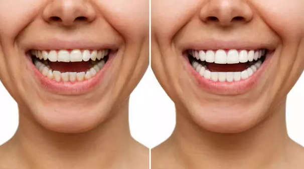 Tooth Whitening & Veneers