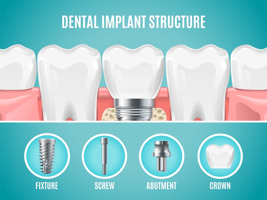 Dental Implant Fixing