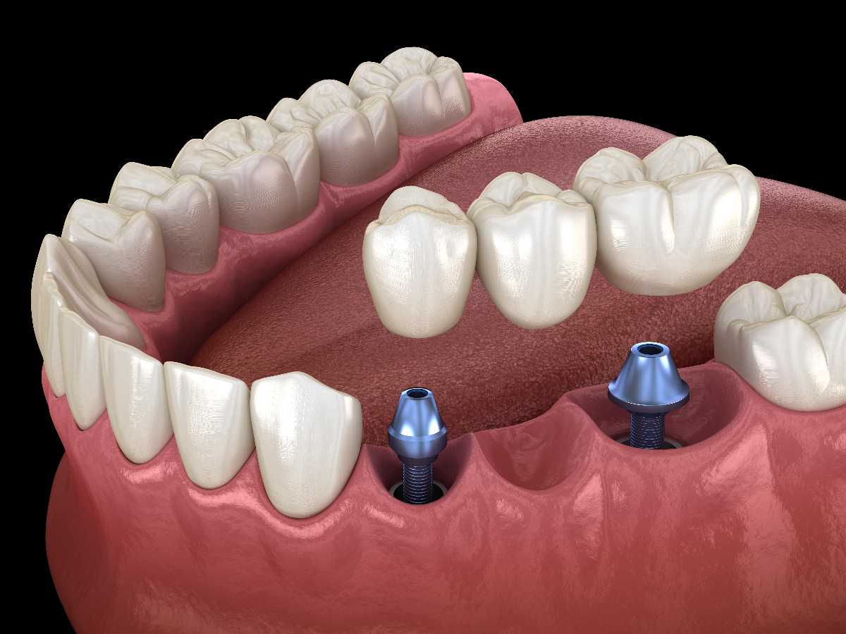 Prosthodontics