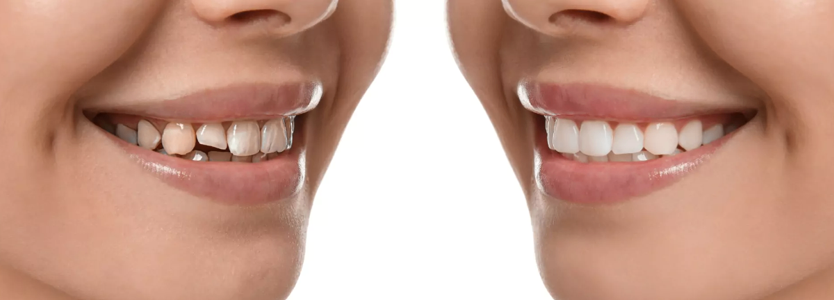 Smile Designing & Cosmetic Dentistry