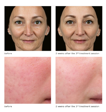 Polynucleotide before and after results - facial rejuvenation