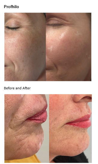 Profhilo before and after results - facial skin rejuvenation