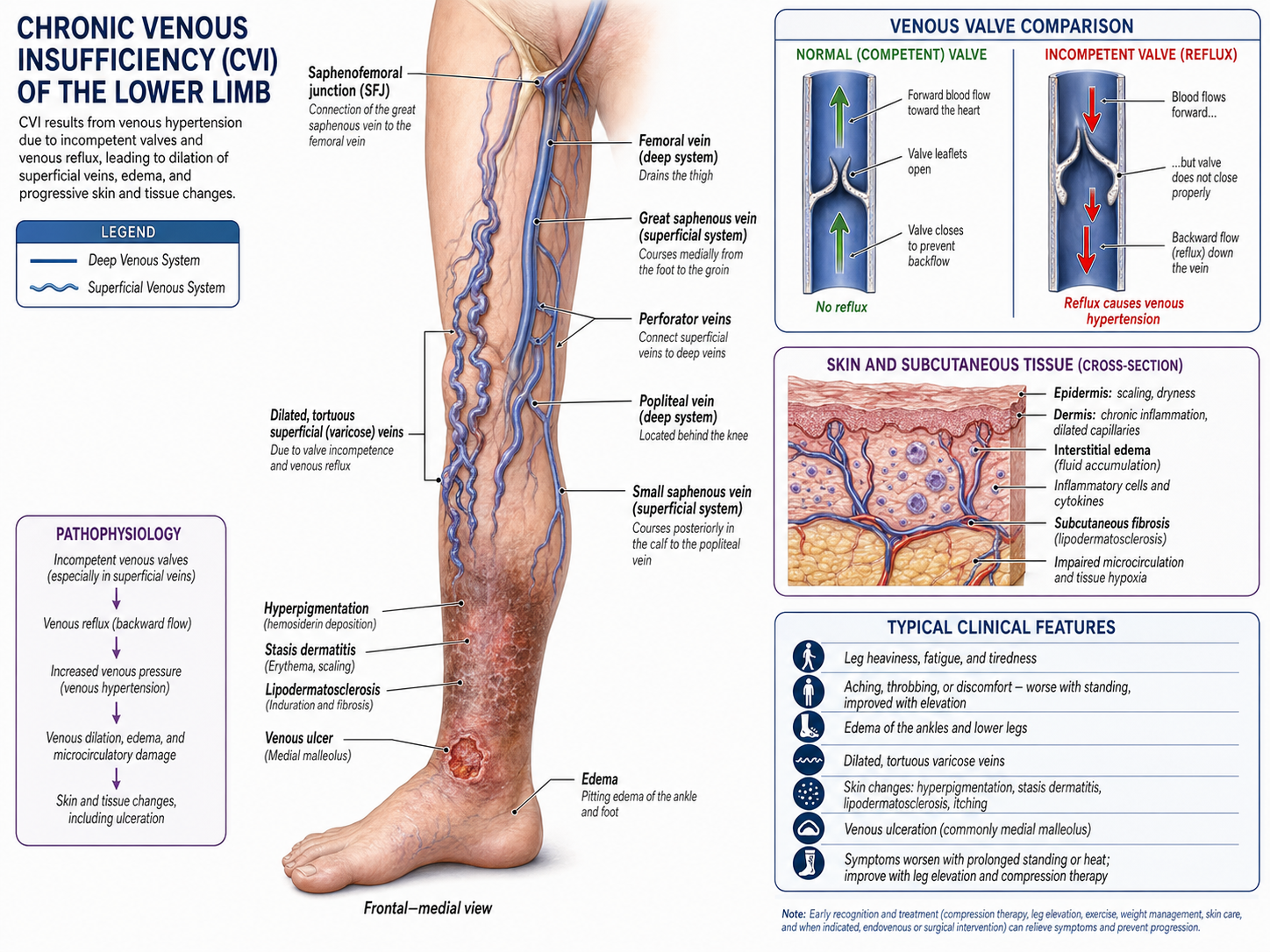 Chronic Venous Insufficiency