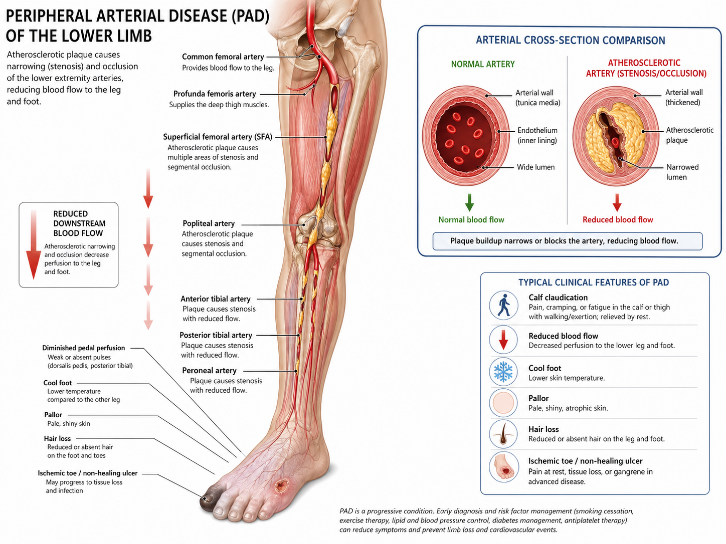 Peripheral Artery Disease