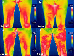Analisi Termografica Cellulite con Termocamera