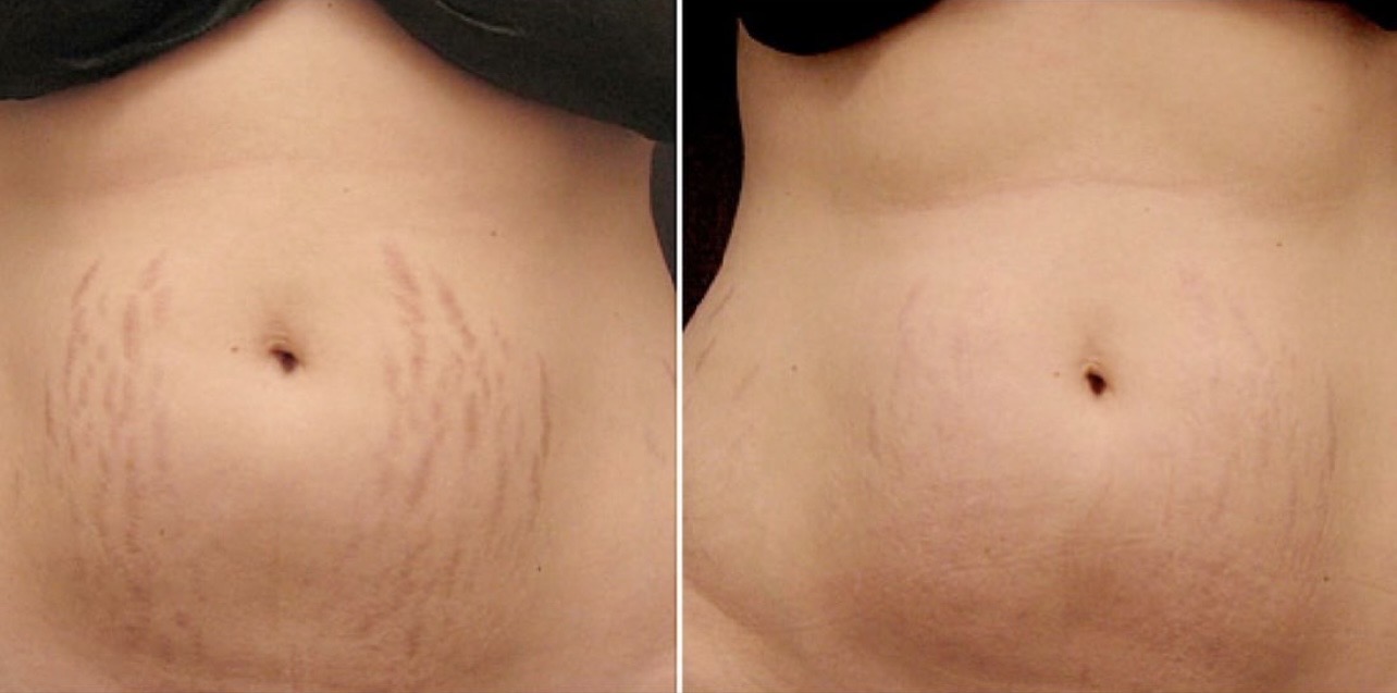 Skin rejuvenation results