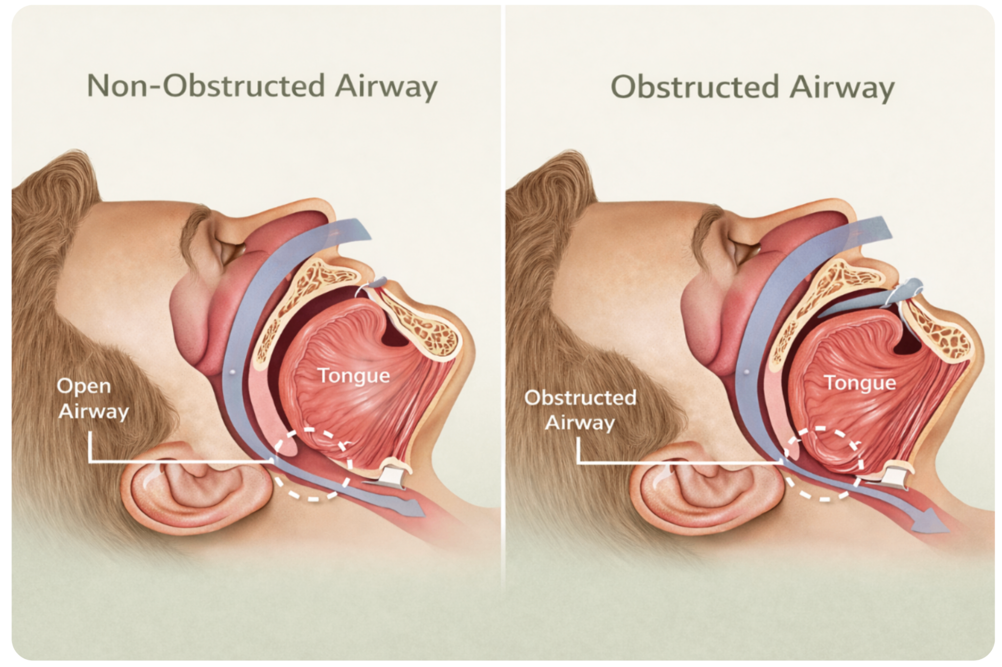 Medical diagram showing airway narrowing during obstructive sleep apnoea compared to normal airway