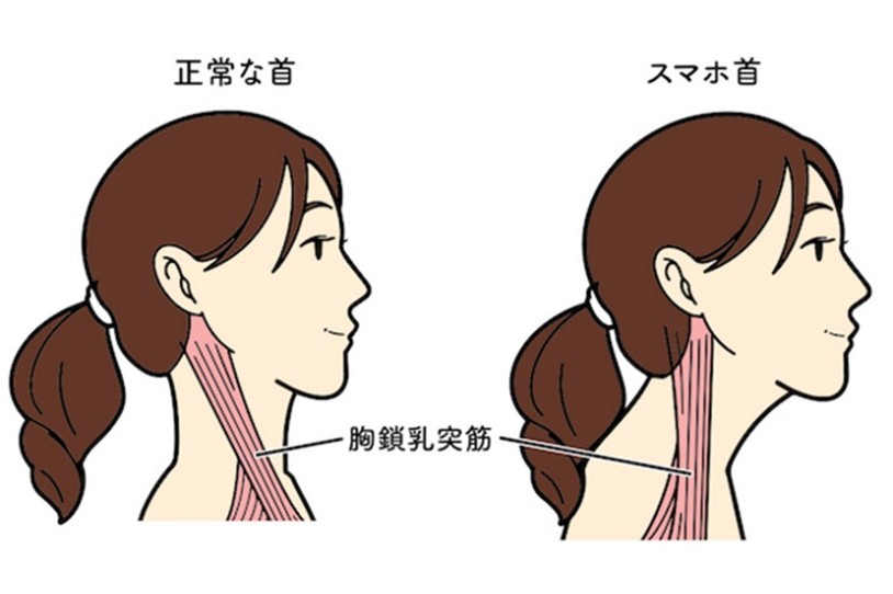 施術後の良い状態が続かない理由の説明図